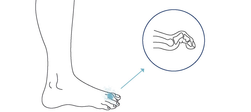 Illustration af hammertå - Sahva