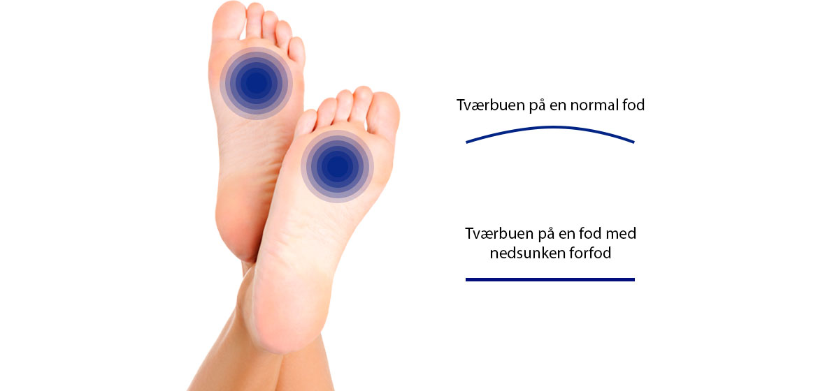 Nedsunken forfod sker af en sunken tværbue - Sahva
