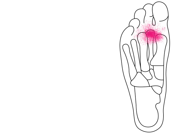 Fodfodssmerter - - - Har - (metatarsalgia)