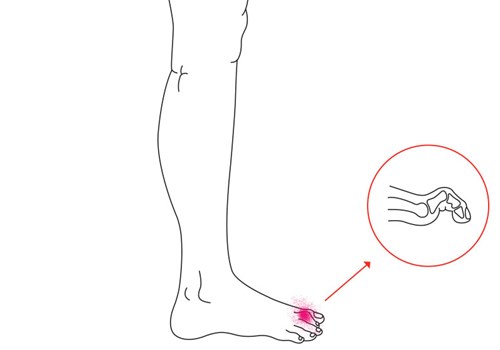 Illustration af hammertå - Sahva