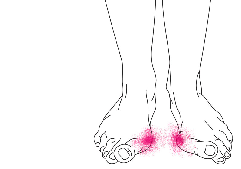 Redaktør appetit Spole tilbage Har du problemer med knyster ved storetåen? - (hallux valgus)