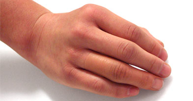 Fingerprotese - Sahva