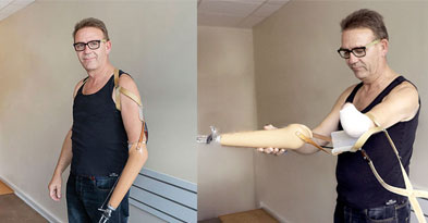 Armprotesen af og på - Sahva