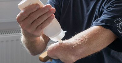 Mand påfører creme på sin armstump - Sahva